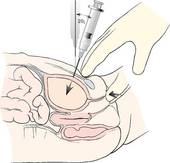 Altered needle position for SPA