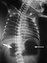 Figure 1: X-ray showing 'double bubble' in duodenal atresia